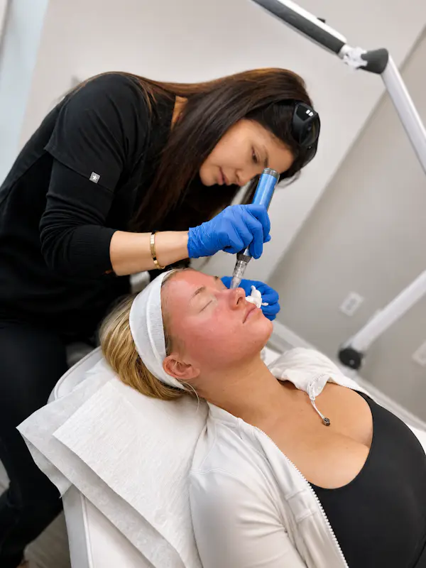 Patient receiving facial microneedling treatment for anti-aging and skin texture at Refresh - Aesthetics & Wellness in Florida